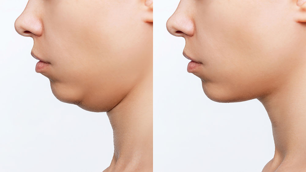 Liposuction Double Chin Cropped Shot Woman S Face With Chin Before After Plastic Surgery